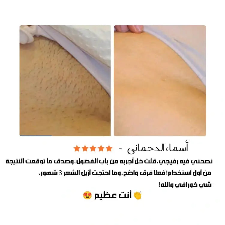 بديل الليزر اللي كنت تنتظره …!!   نفس النتيجة بدون حروق او الم